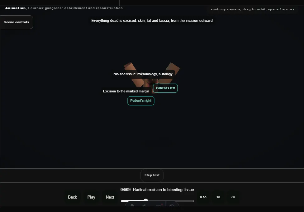 Fournier gangrene: debridement and reconstruction. Step 4: Radical excision to bleeding tissue. Captured frame from the interactive animation.