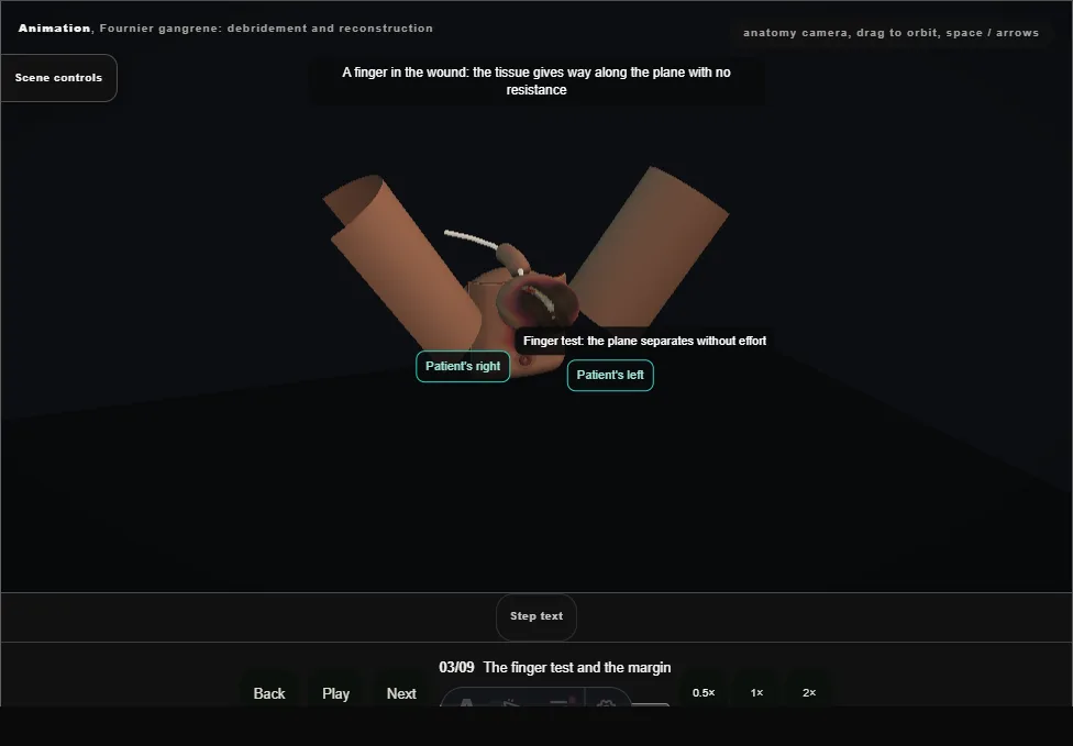 Fournier gangrene: debridement and reconstruction. Step 3: The finger test and the margin. Captured frame from the interactive animation.