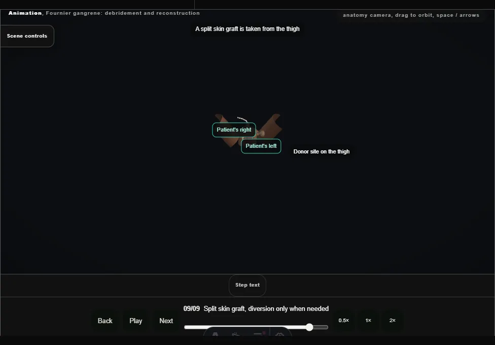 Fournier gangrene: debridement and reconstruction. Step 9: Split skin graft, diversion only when needed. Captured frame from the interactive animation.