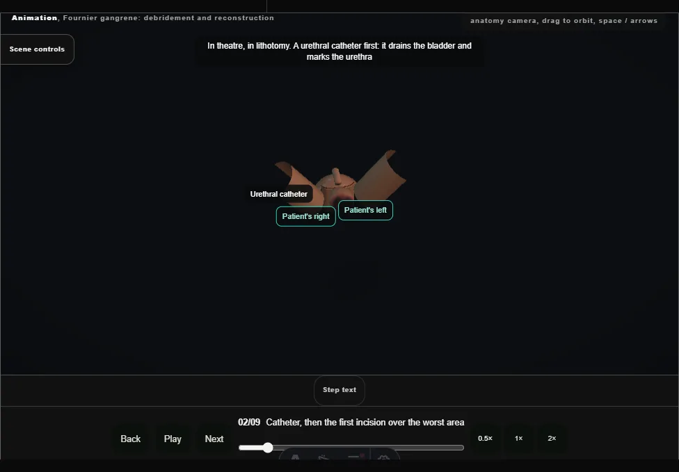 Fournier gangrene: debridement and reconstruction. Step 2: Catheter, then the first incision over the worst area. Captured frame from the interactive animation.