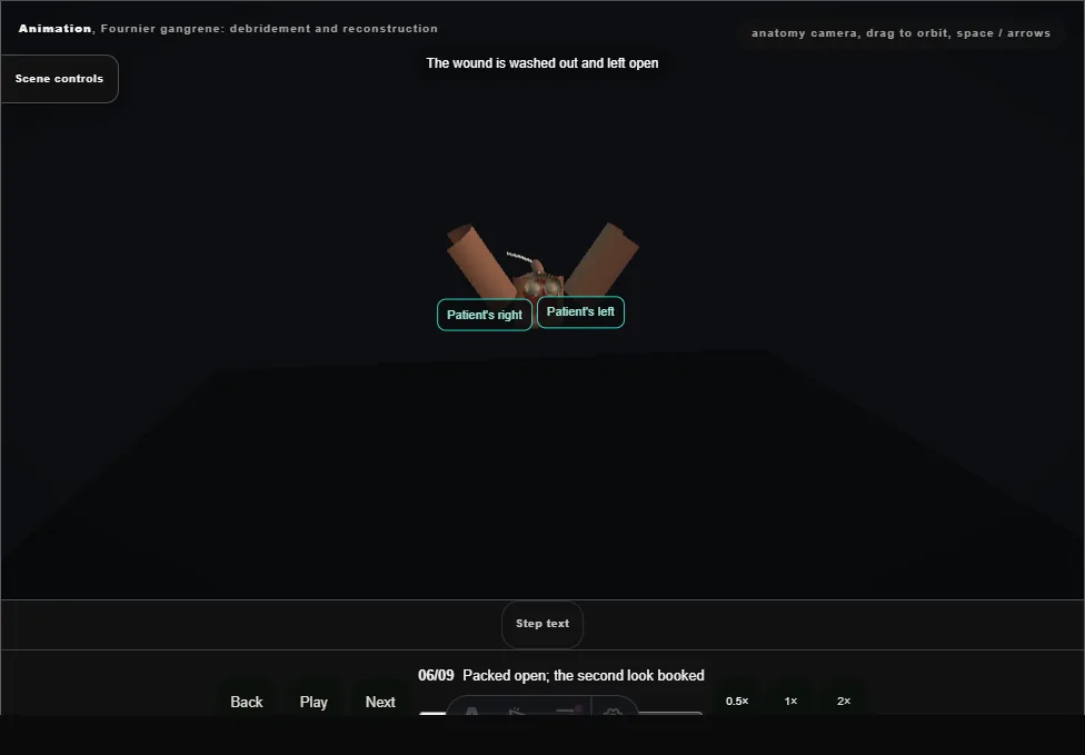 Fournier gangrene: debridement and reconstruction. Step 6: Packed open; the second look booked. Captured frame from the interactive animation.