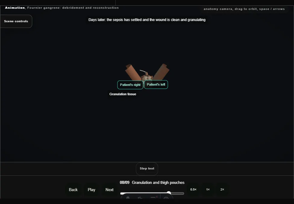 Fournier gangrene: debridement and reconstruction. Step 8: Granulation and thigh pouches. Captured frame from the interactive animation.