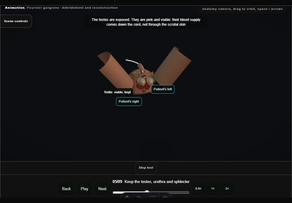 Fournier gangrene: debridement and reconstruction. Step 5: Keep the testes, urethra and sphincter. Captured frame from the interactive animation.