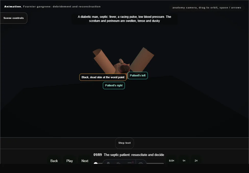 Fournier gangrene: debridement and reconstruction. Step 1: The septic patient: resuscitate and decide. Captured frame from the interactive animation.