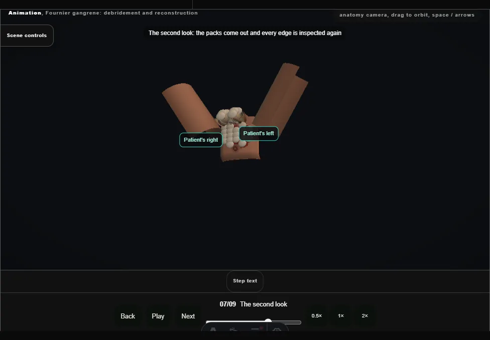 Fournier gangrene: debridement and reconstruction. Step 7: The second look. Captured frame from the interactive animation.