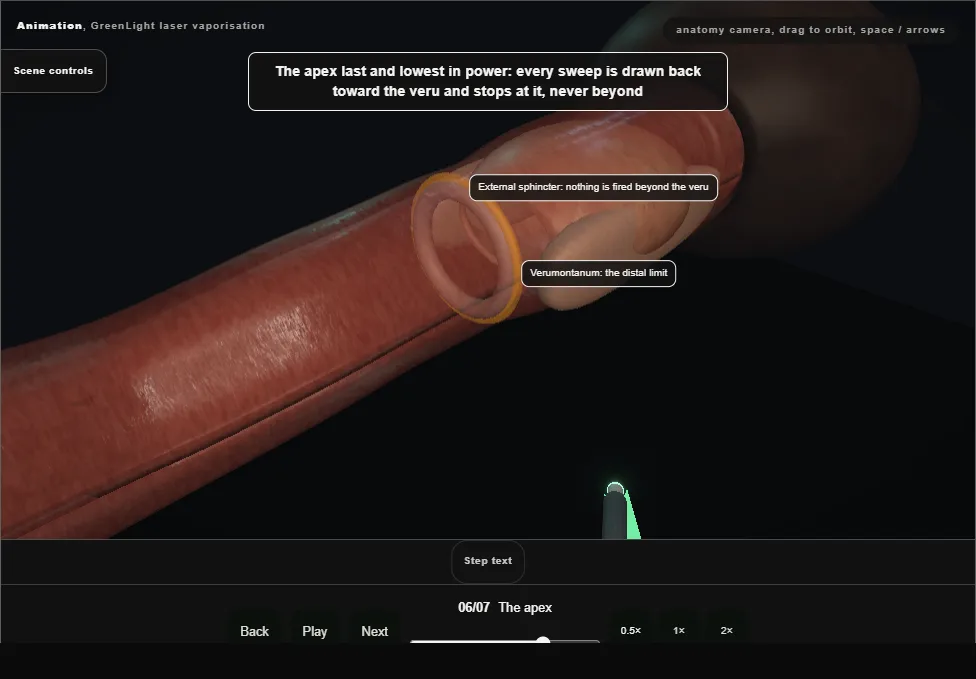 GreenLight laser vaporisation. Step 6: The apex. Captured frame from the interactive animation.