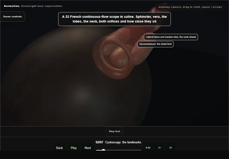 GreenLight laser vaporisation. Step 2: Cystoscopy: the landmarks. Captured frame from the interactive animation.