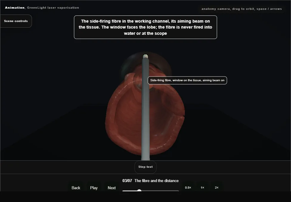 GreenLight laser vaporisation. Step 3: The fibre and the distance. Captured frame from the interactive animation.