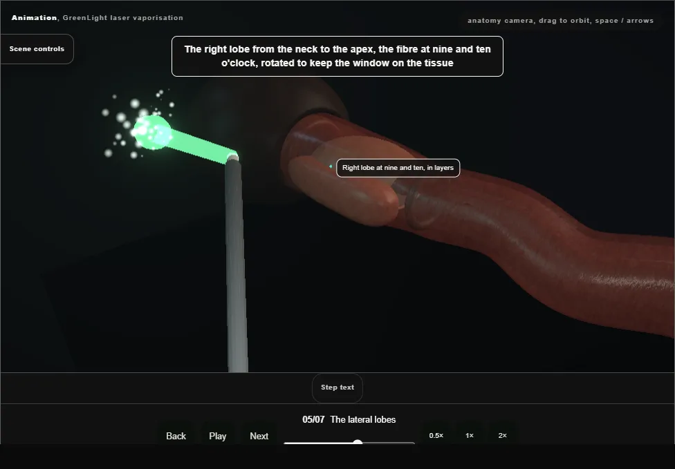 GreenLight laser vaporisation. Step 5: The lateral lobes. Captured frame from the interactive animation.