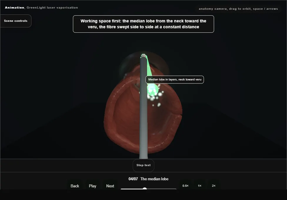 GreenLight laser vaporisation. Step 4: The median lobe. Captured frame from the interactive animation.