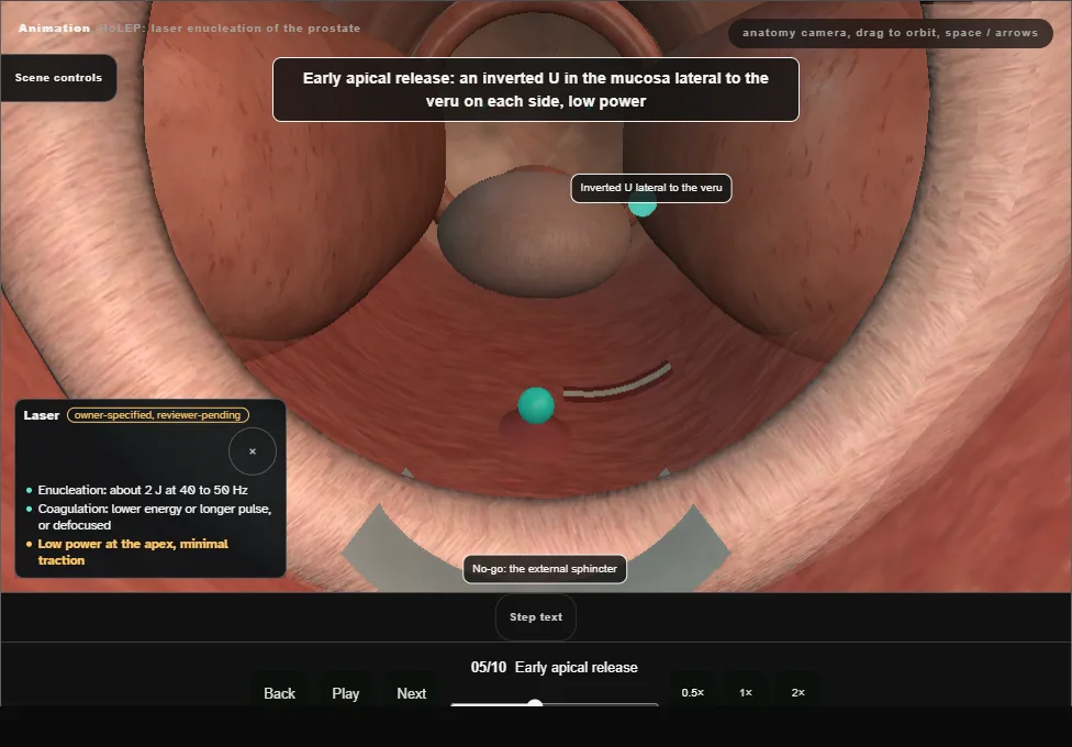 HoLEP: laser enucleation of the prostate. Step 5: Early apical release. Captured frame from the interactive animation.