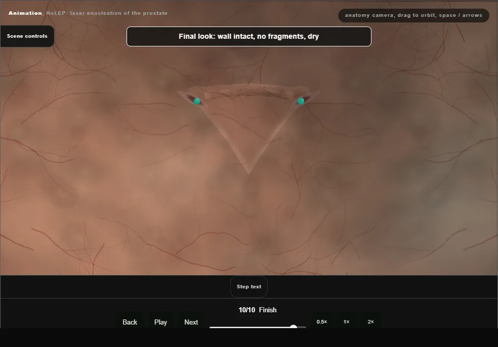 HoLEP: laser enucleation of the prostate. Step 10: Finish. Captured frame from the interactive animation.