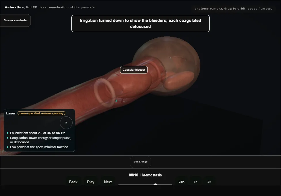 HoLEP: laser enucleation of the prostate. Step 8: Haemostasis. Captured frame from the interactive animation.