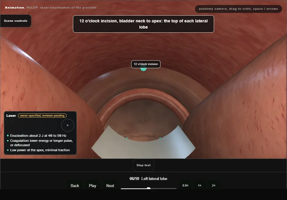 HoLEP: laser enucleation of the prostate. Step 6: Left lateral lobe. Captured frame from the interactive animation.
