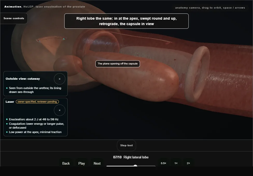 HoLEP: laser enucleation of the prostate. Step 7: Right lateral lobe. Captured frame from the interactive animation.