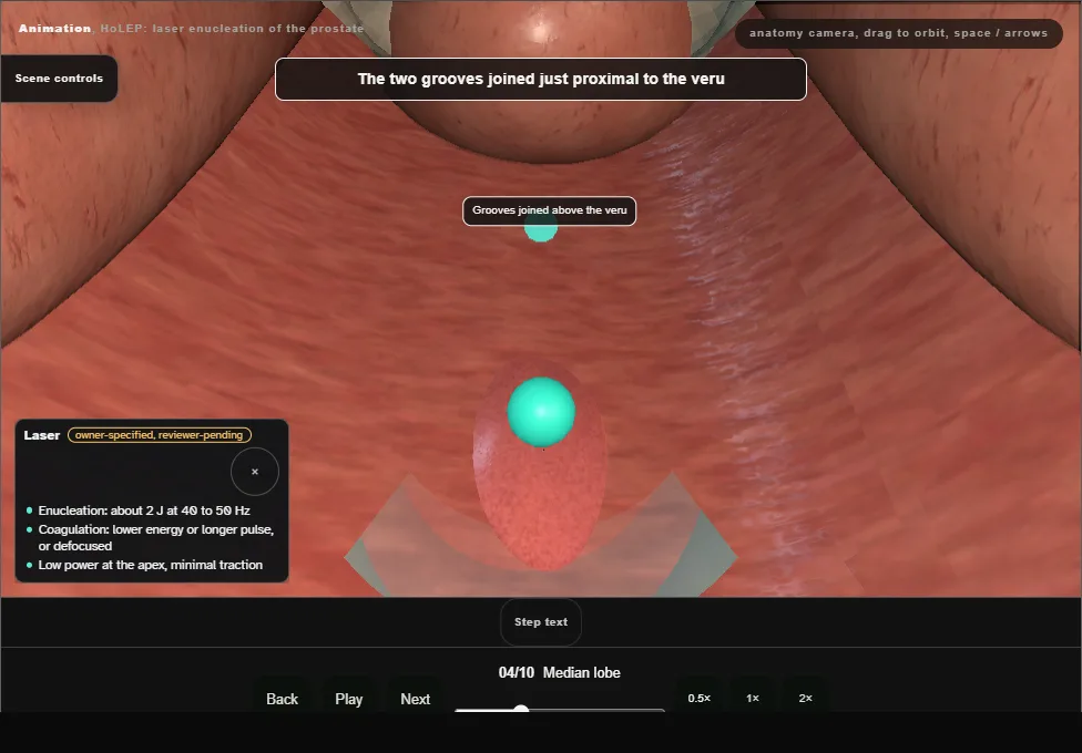 HoLEP: laser enucleation of the prostate. Step 4: Median lobe. Captured frame from the interactive animation.
