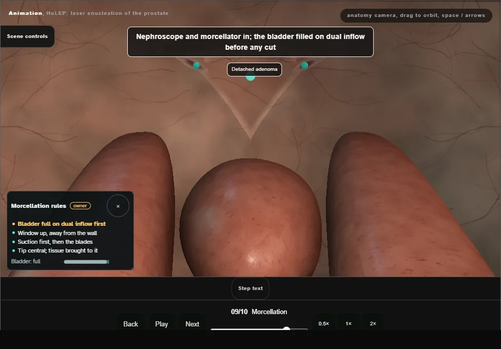 HoLEP: laser enucleation of the prostate. Step 9: Morcellation. Captured frame from the interactive animation.