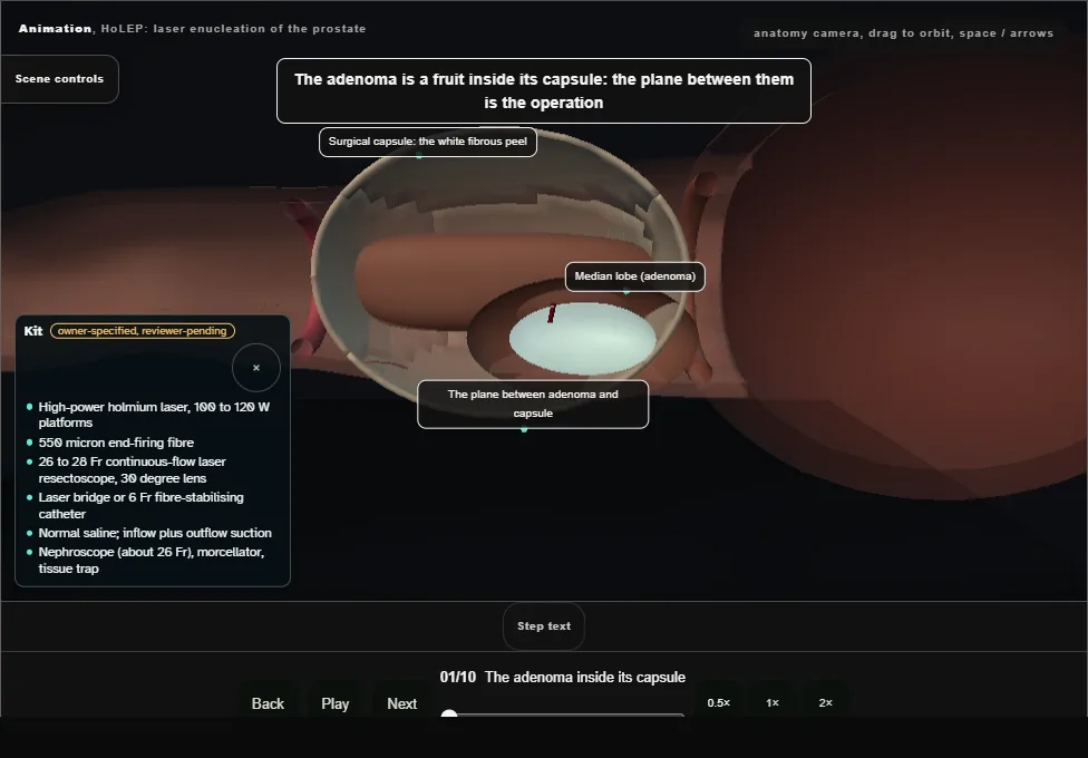 HoLEP: laser enucleation of the prostate. Step 1: The adenoma inside its capsule. Captured frame from the interactive animation.
