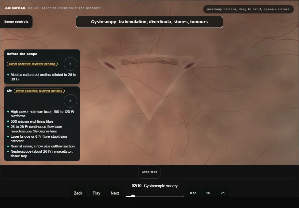 HoLEP: laser enucleation of the prostate. Step 2: Cystoscopic survey. Captured frame from the interactive animation.