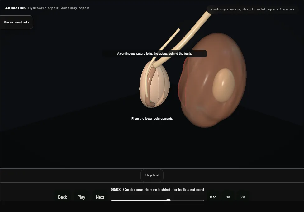 Hydrocele repair: Jaboulay repair. Step 6: Continuous closure behind the testis and cord. Captured frame from the interactive animation.