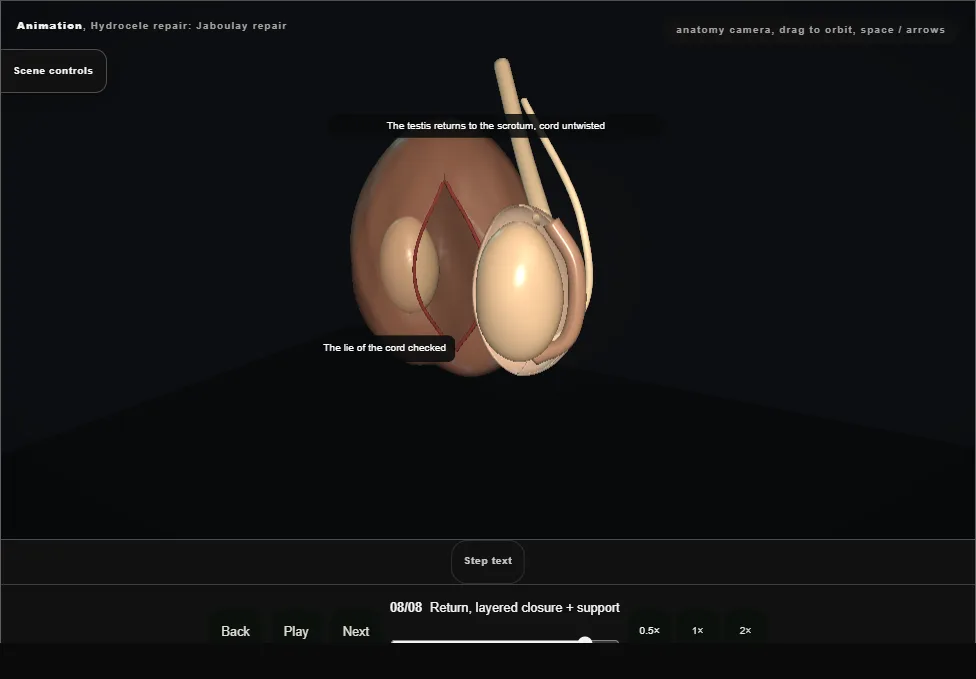 Hydrocele repair: Jaboulay repair. Step 8: Return, layered closure + support. Captured frame from the interactive animation.