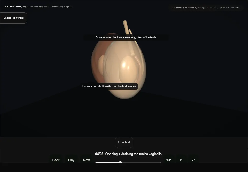 Hydrocele repair: Jaboulay repair. Step 4: Opening + draining the tunica vaginalis. Captured frame from the interactive animation.
