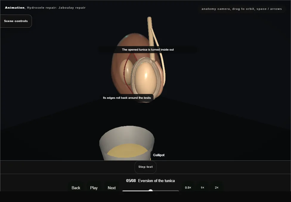 Hydrocele repair: Jaboulay repair. Step 5: Eversion of the tunica. Captured frame from the interactive animation.