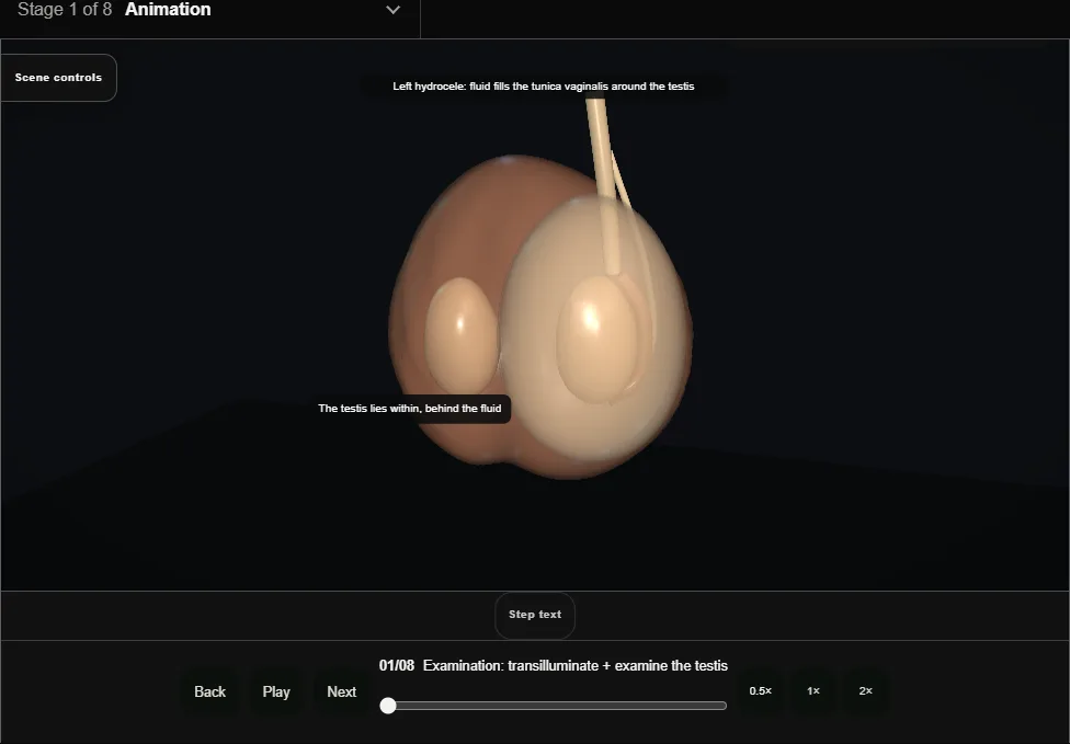Hydrocele repair: Jaboulay repair. Step 1: Examination: transilluminate + examine the testis. Captured frame from the interactive animation.
