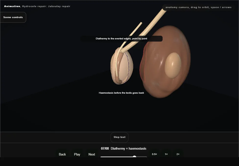 Hydrocele repair: Jaboulay repair. Step 7: Diathermy + haemostasis. Captured frame from the interactive animation.