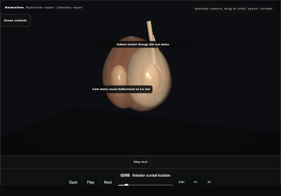 Hydrocele repair: Jaboulay repair. Step 2: Anterior scrotal incision. Captured frame from the interactive animation.