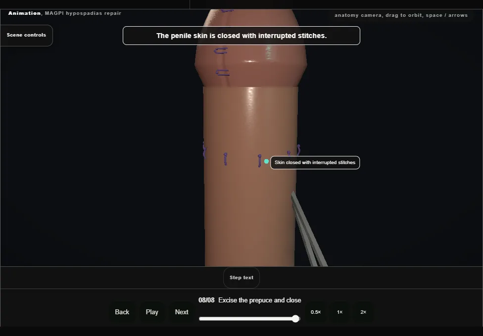 MAGPI hypospadias repair. Step 8: Excise the prepuce and close. Captured frame from the interactive animation.