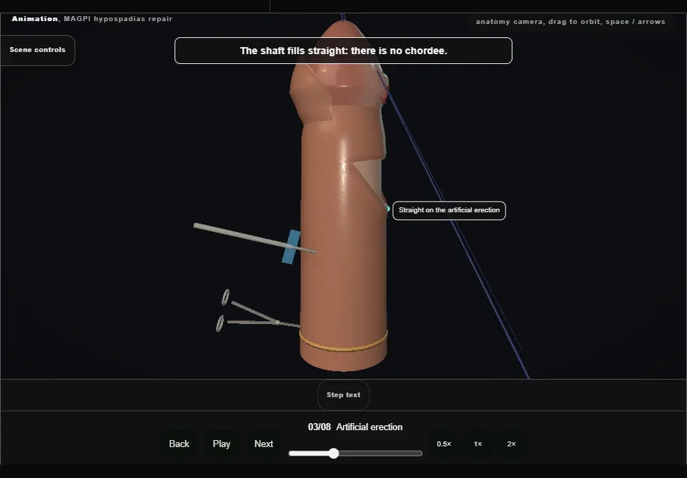 MAGPI hypospadias repair. Step 3: Artificial erection. Captured frame from the interactive animation.