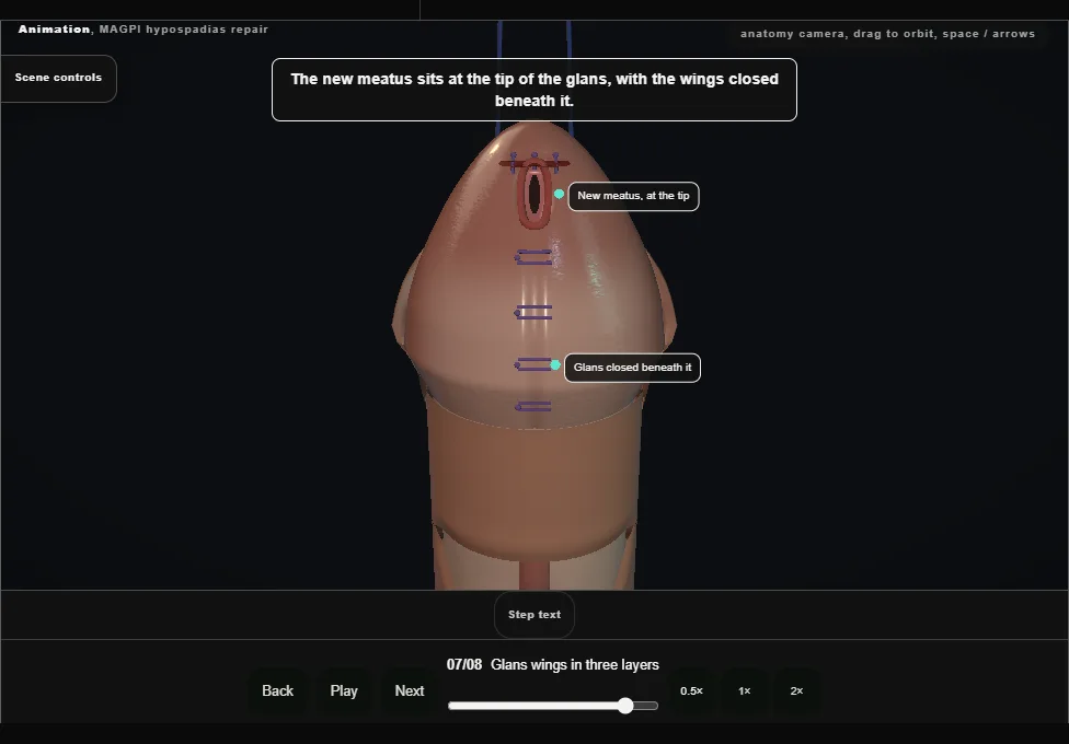 MAGPI hypospadias repair. Step 7: Glans wings in three layers. Captured frame from the interactive animation.