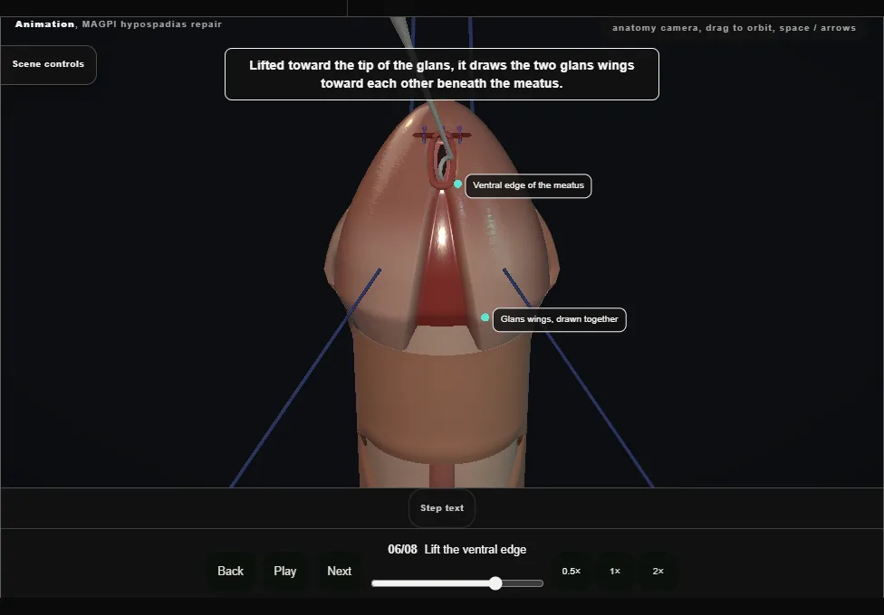 MAGPI hypospadias repair. Step 6: Lift the ventral edge. Captured frame from the interactive animation.
