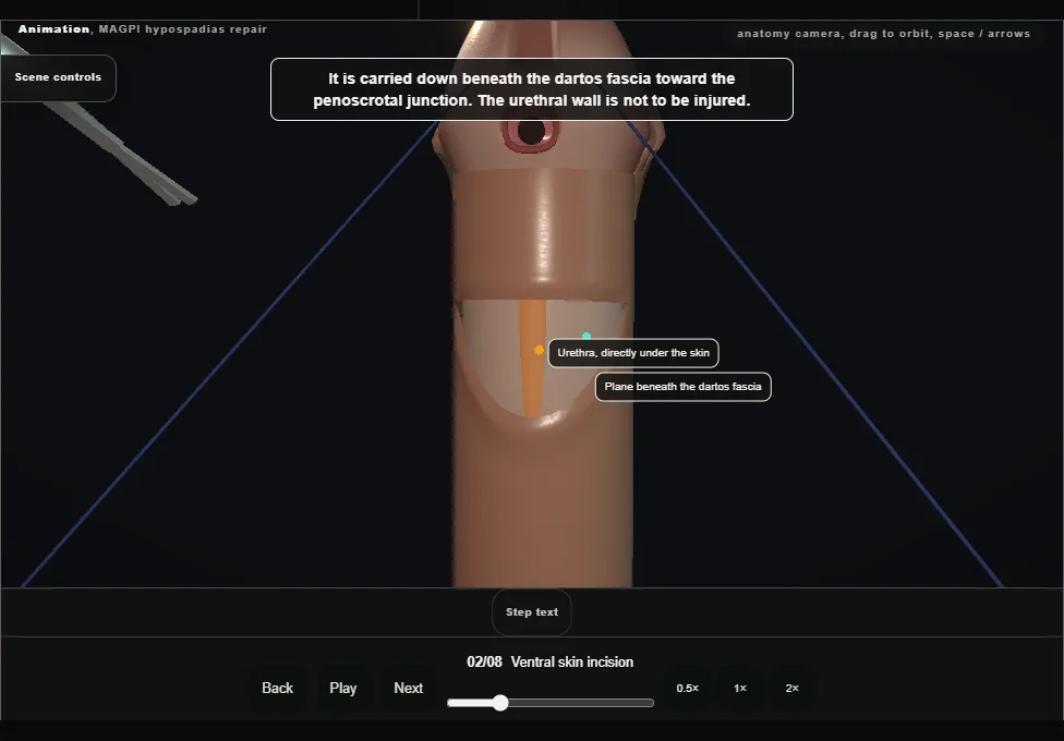 MAGPI hypospadias repair. Step 2: Ventral skin incision. Captured frame from the interactive animation.