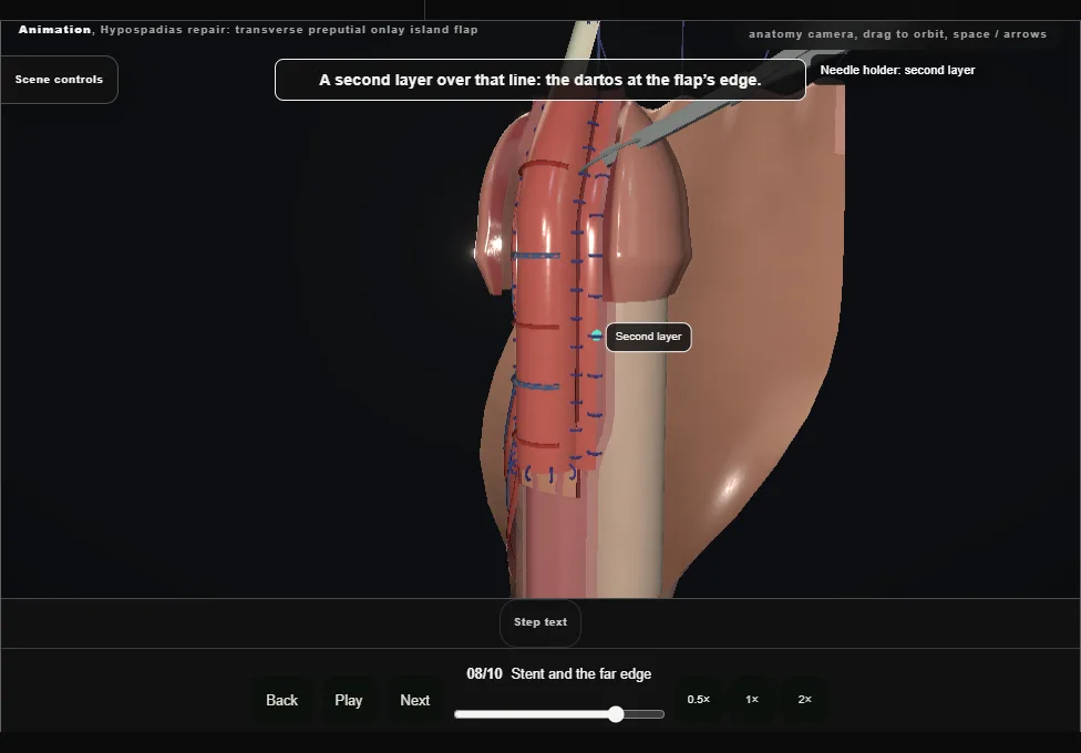 Hypospadias repair: transverse preputial onlay island flap. Step 8: Stent and the far edge. Captured frame from the interactive animation.