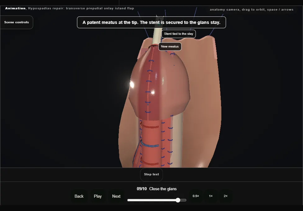 Hypospadias repair: transverse preputial onlay island flap. Step 9: Close the glans. Captured frame from the interactive animation.