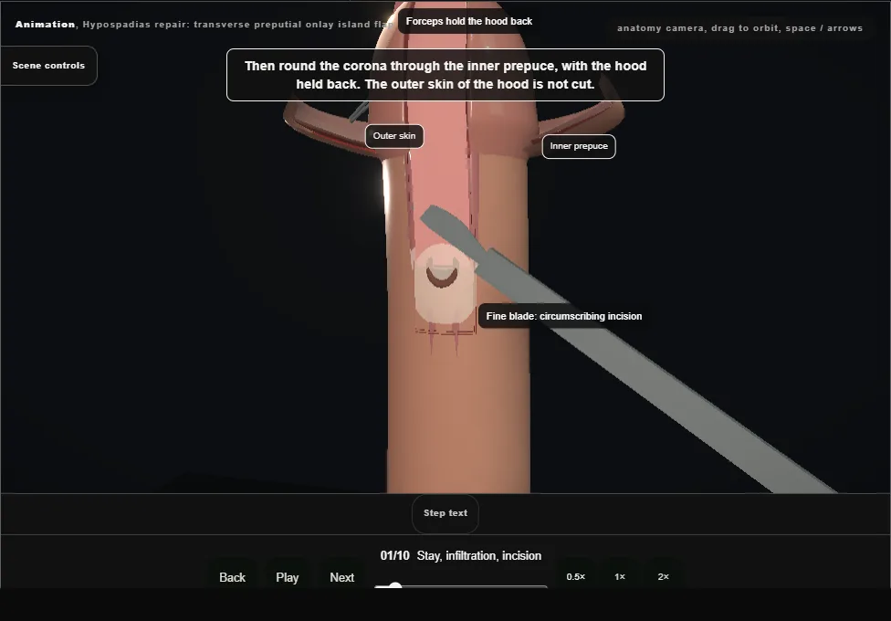 Hypospadias repair: transverse preputial onlay island flap. Step 1: Stay, infiltration, incision. Captured frame from the interactive animation.