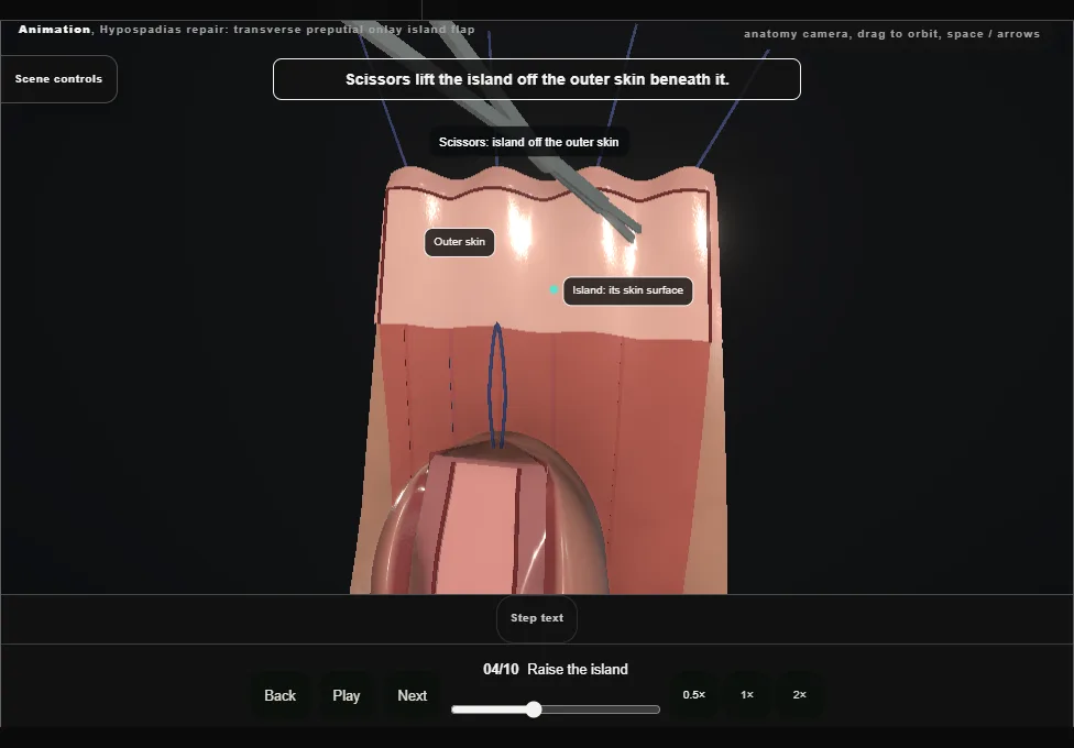 Hypospadias repair: transverse preputial onlay island flap. Step 4: Raise the island. Captured frame from the interactive animation.