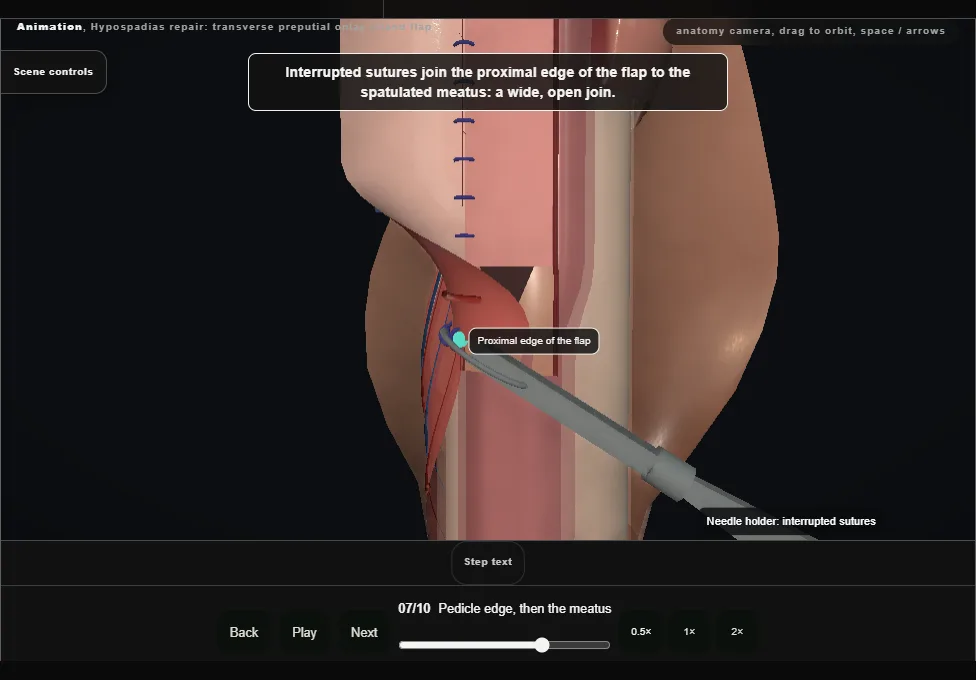 Hypospadias repair: transverse preputial onlay island flap. Step 7: Pedicle edge, then the meatus. Captured frame from the interactive animation.