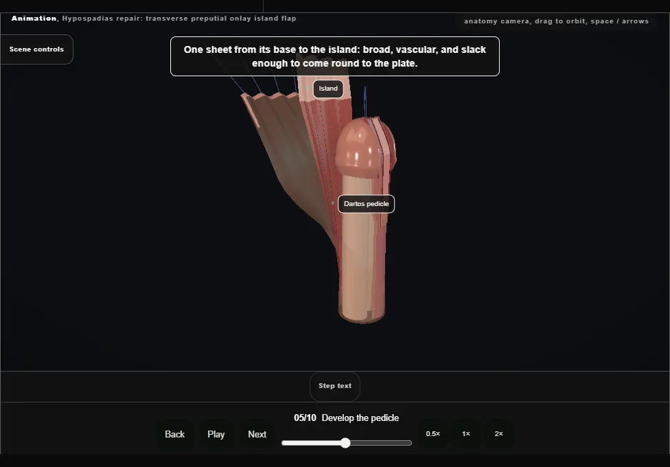 Hypospadias repair: transverse preputial onlay island flap. Step 5: Develop the pedicle. Captured frame from the interactive animation.
