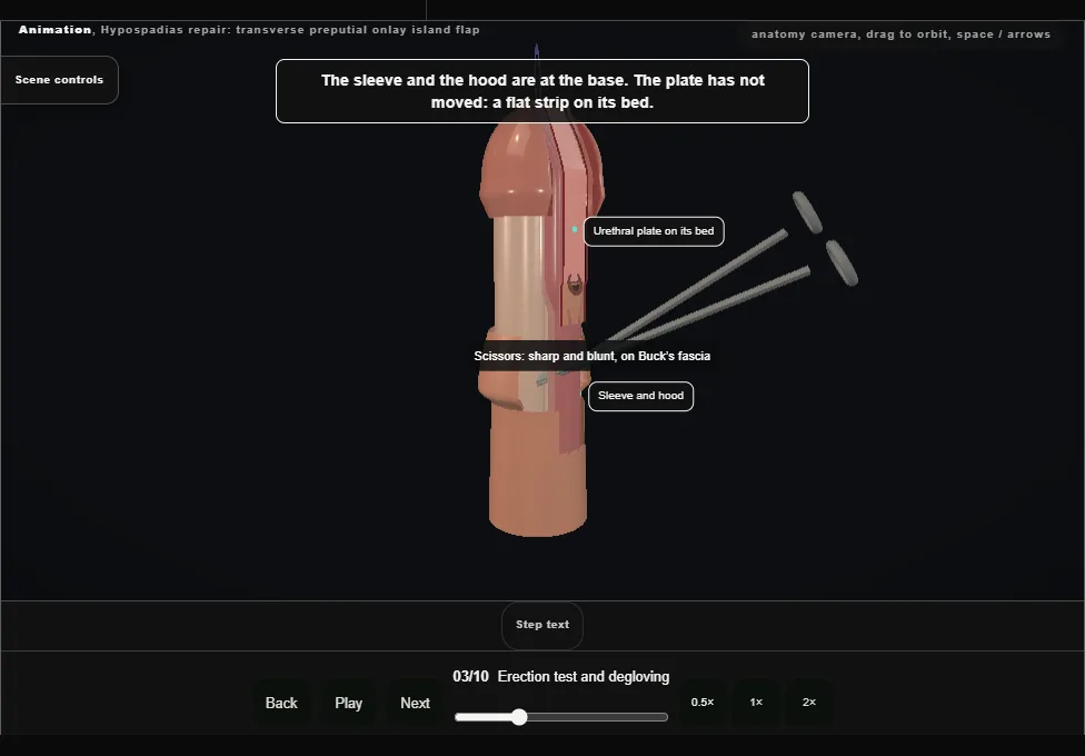 Hypospadias repair: transverse preputial onlay island flap. Step 3: Erection test and degloving. Captured frame from the interactive animation.