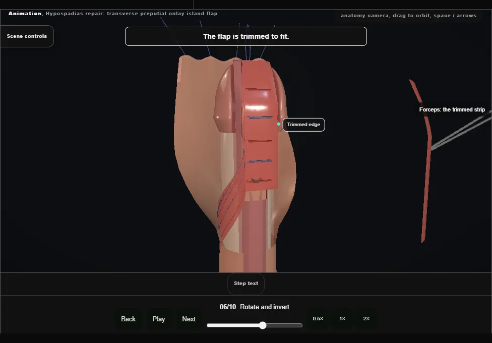 Hypospadias repair: transverse preputial onlay island flap. Step 6: Rotate and invert. Captured frame from the interactive animation.