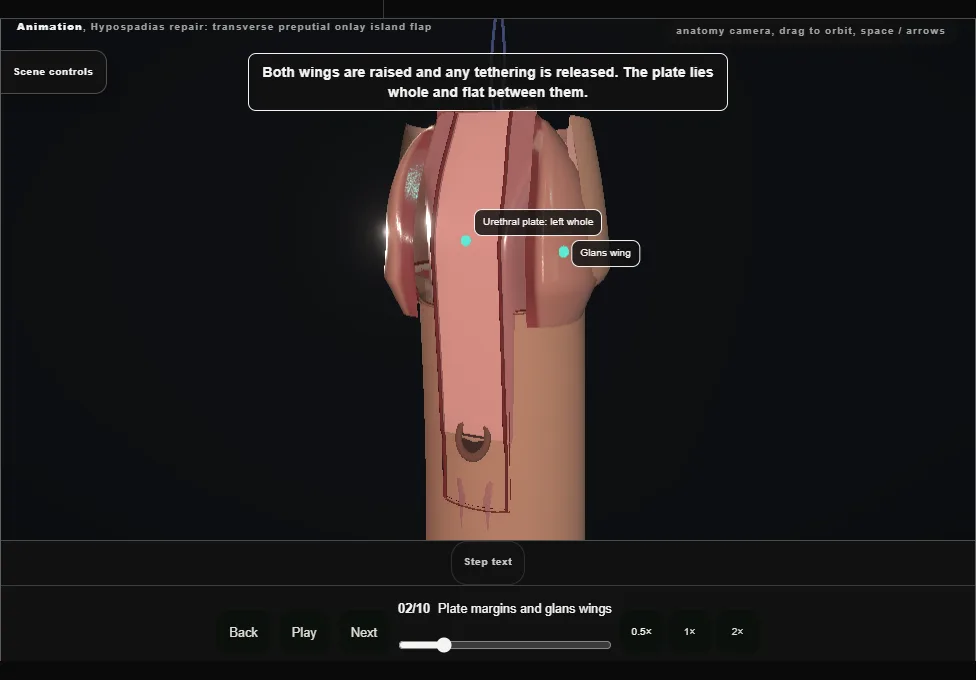 Hypospadias repair: transverse preputial onlay island flap. Step 2: Plate margins and glans wings. Captured frame from the interactive animation.
