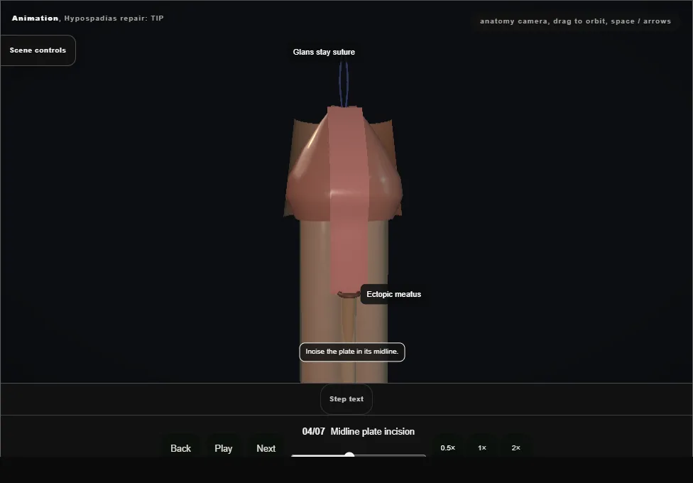 Hypospadias repair: TIP. Step 4: Midline plate incision. Captured frame from the interactive animation.