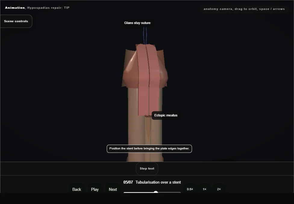 Hypospadias repair: TIP. Step 5: Tubularisation over a stent. Captured frame from the interactive animation.