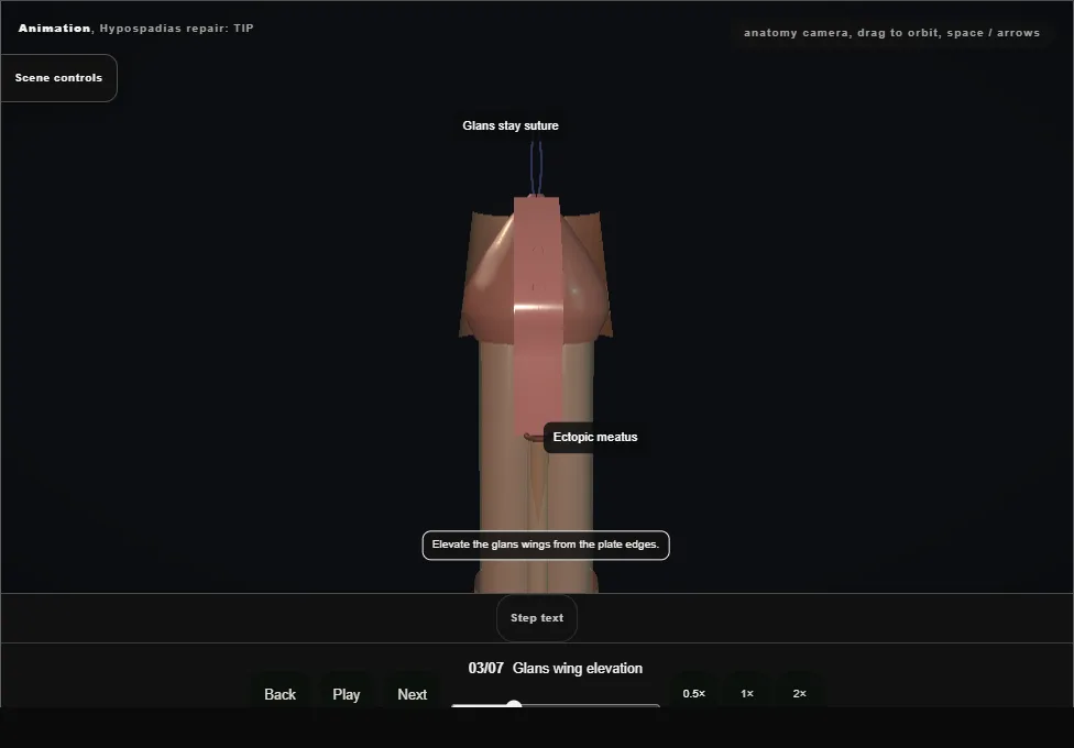 Hypospadias repair: TIP. Step 3: Glans wing elevation. Captured frame from the interactive animation.