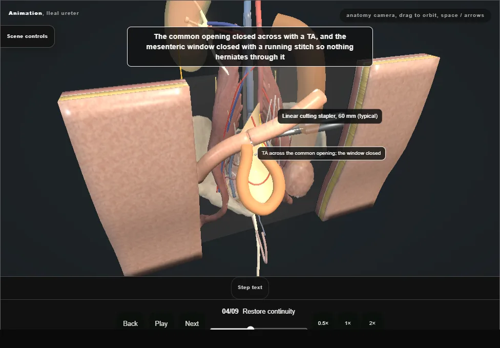 Ileal ureter. Step 4: Restore continuity. Captured frame from the interactive animation.