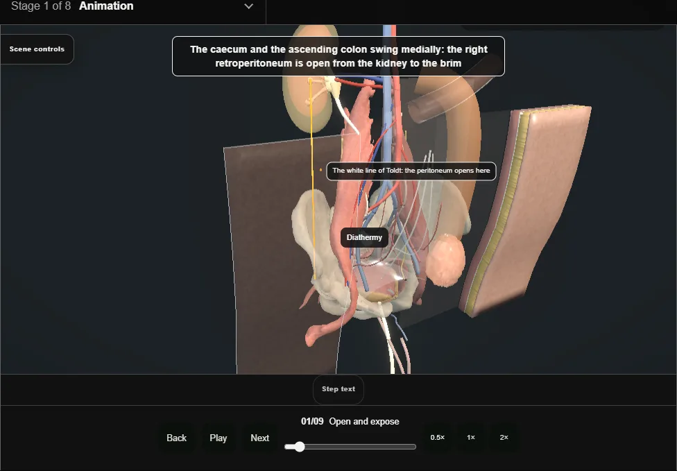 Ileal ureter. Step 1: Open and expose. Captured frame from the interactive animation.