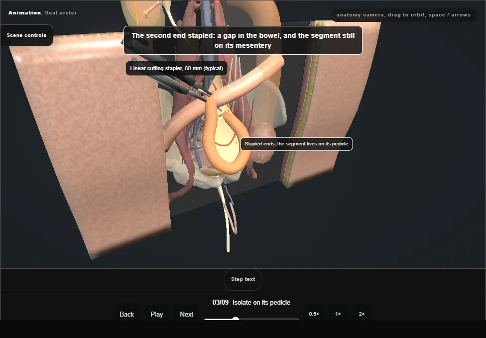 Ileal ureter. Step 3: Isolate on its pedicle. Captured frame from the interactive animation.